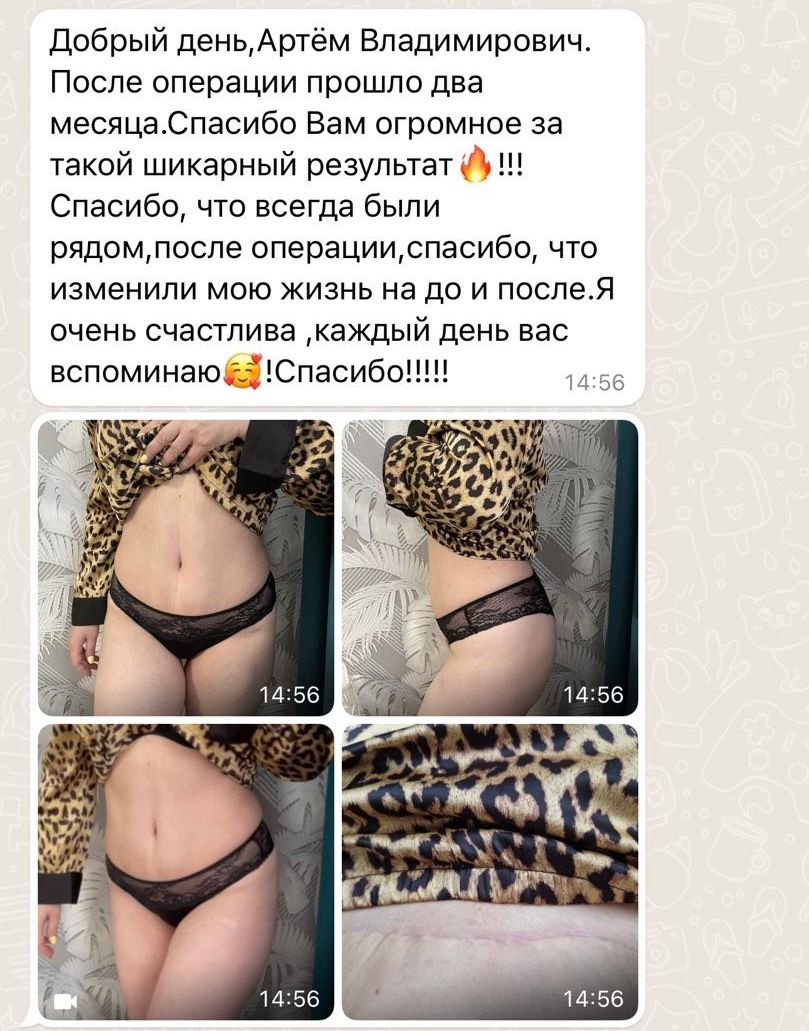 Добрый день, Артём Владимирович. После операции прошло два месяца. Спасибо Вам огромное за такой шикарный результат 🔥!!! Спасибо, что всегда были рядом, после операции, спасибо, что изменили мою жизнь на до и после. Я очень счастлива, каждый день вас вспоминаю 🥰! Спасибо!!!!!