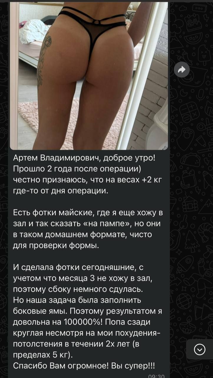 Артем Владимирович, доброе утро! Прошло 2 года после операции) честно признаюсь, что на весах +2 кг где-то от дня операции. Есть фотки майские, где я еще хожу в зал и так сказать «на пампе», но они в таком домашнем формате, чисто для проверки формы. И сделала фотки сегодняшние, с учетом что месяца 3 не хожу в зал, поэтому сбоку немного сдулась. Но наша задача была заполнить боковые ямы. Поэтому результатом я довольна на 100000%! Попа сзади круглая несмотря на мои похудения-потолстения в течении 2х лет (в пределах 5 кг). Спасибо Вам огромное! Вы супер!!!