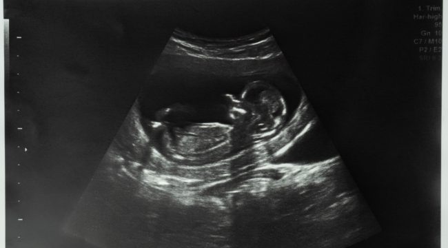 Число абортов в Великобритании достигло исторического максимума, требуя пересмотра закона