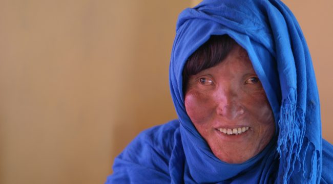 Лепра: библейская болезнь все еще угрожает человечеству