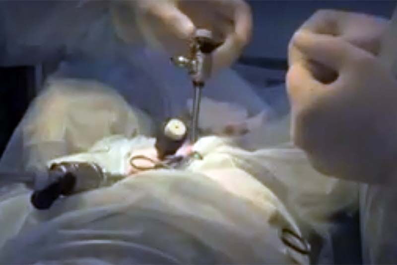 В Тюмени кардиохирурги провели уникальную операцию пятилетней девочке