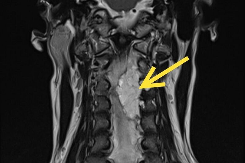 Курганские нейрохирурги спасли мужчину из Омска от паралича