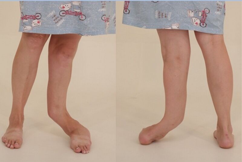 В Кургане провели операцию женщине с крайне сложной деформацией голени после аварии