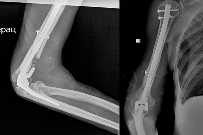 В Кургане врачи Центра Илизарова прооперировали пациента со сложным переломом плеча