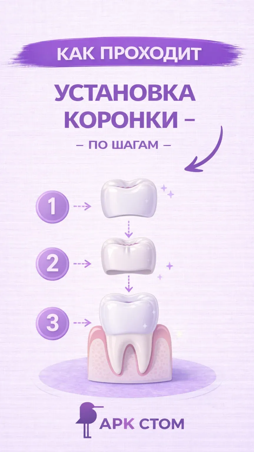 Как проходит установка коронки: этапы лечения от подготовки до фиксации