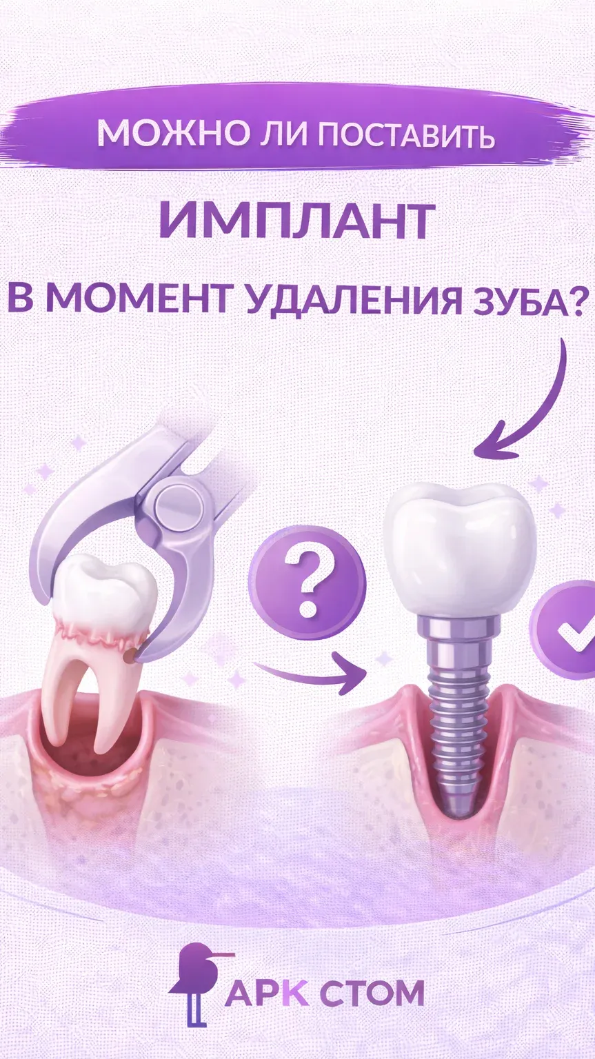 Можно ли поставить имплант сразу после удаления зуба?