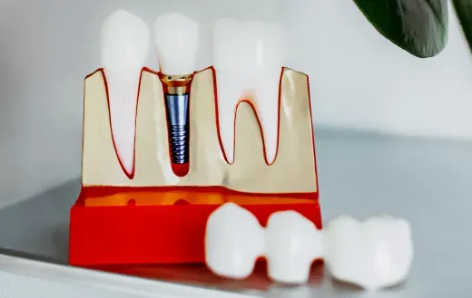 Имплантация под ключ