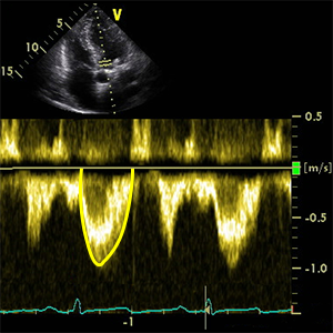 Ударный объем левого желудочка (Stroke Volume / УО) — УЗИ-позиция: PLAX (диаметр LVOT) + A5C (LVOT VTI в PW допплере)