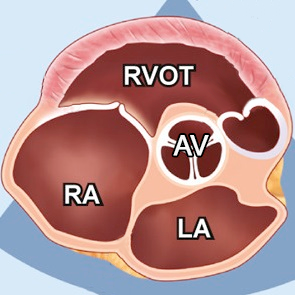 Проксимальный отдел выносящего тракта ПЖ (RVOT prox PSAX) — УЗИ-позиция: PSAX (Парастернальная короткая ось на уровне аортального клапана)