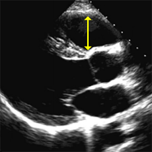 Выносящий тракт правого желудочка в длинной оси (RVOT prox PLAX) — схема измерения