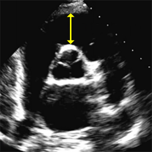 Проксимальный отдел выносящего тракта ПЖ (RVOT prox PSAX) — схема измерения