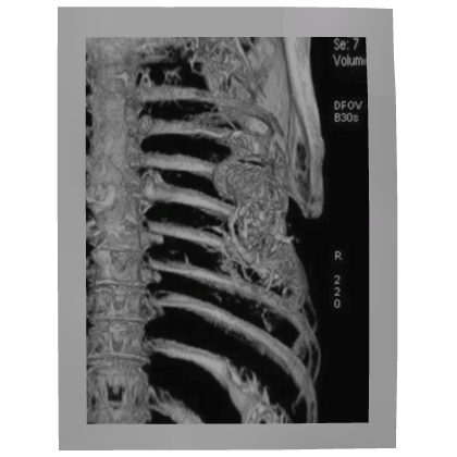 X-RAY RIBCAGE PHOTO